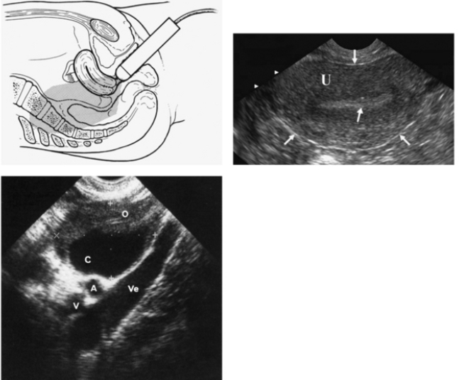 Что показывает УЗИ малого таза у женщин и когда его назначают