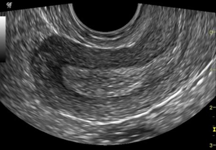 Что показывает УЗИ малого таза у женщин и когда его назначают